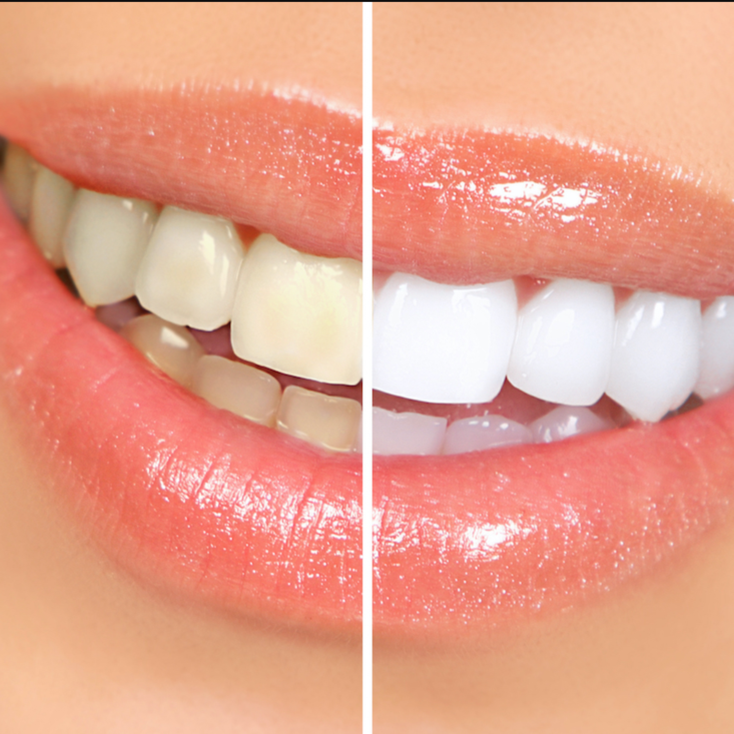 Teeth Whitening at Simply Elegant by Carrie in Portland, IN