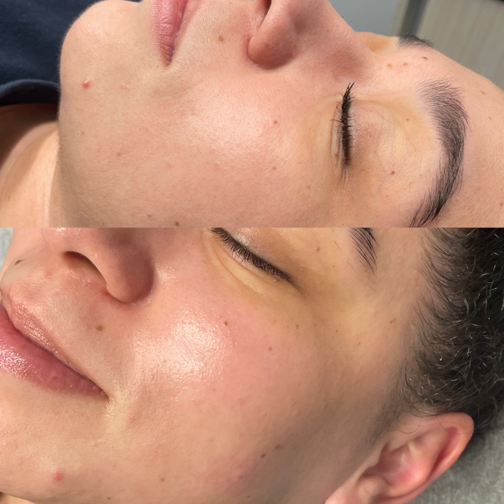 Express dermaplane facial