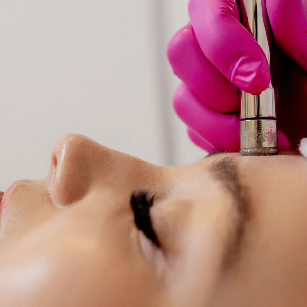 Microdermabrasion