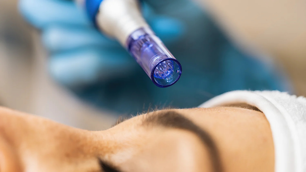Microneedling (Face and Neck)