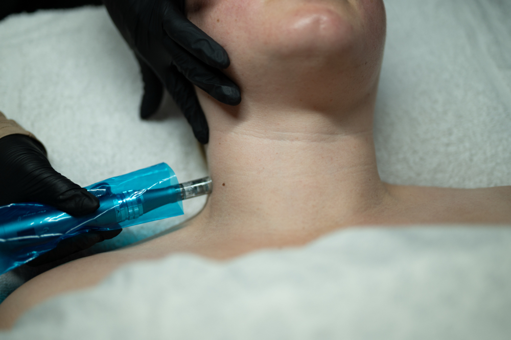 Microneedling (Face and Neck)