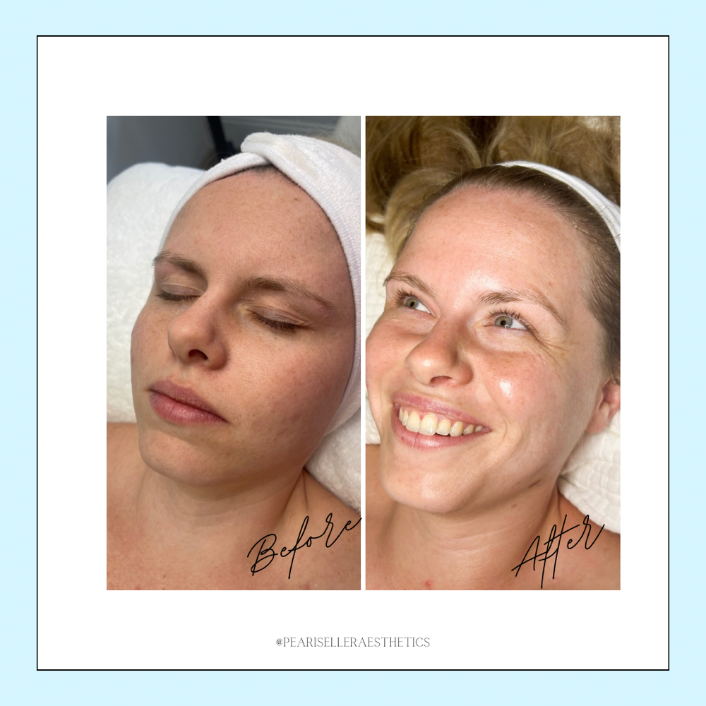 Supreme Glow Customized Facial