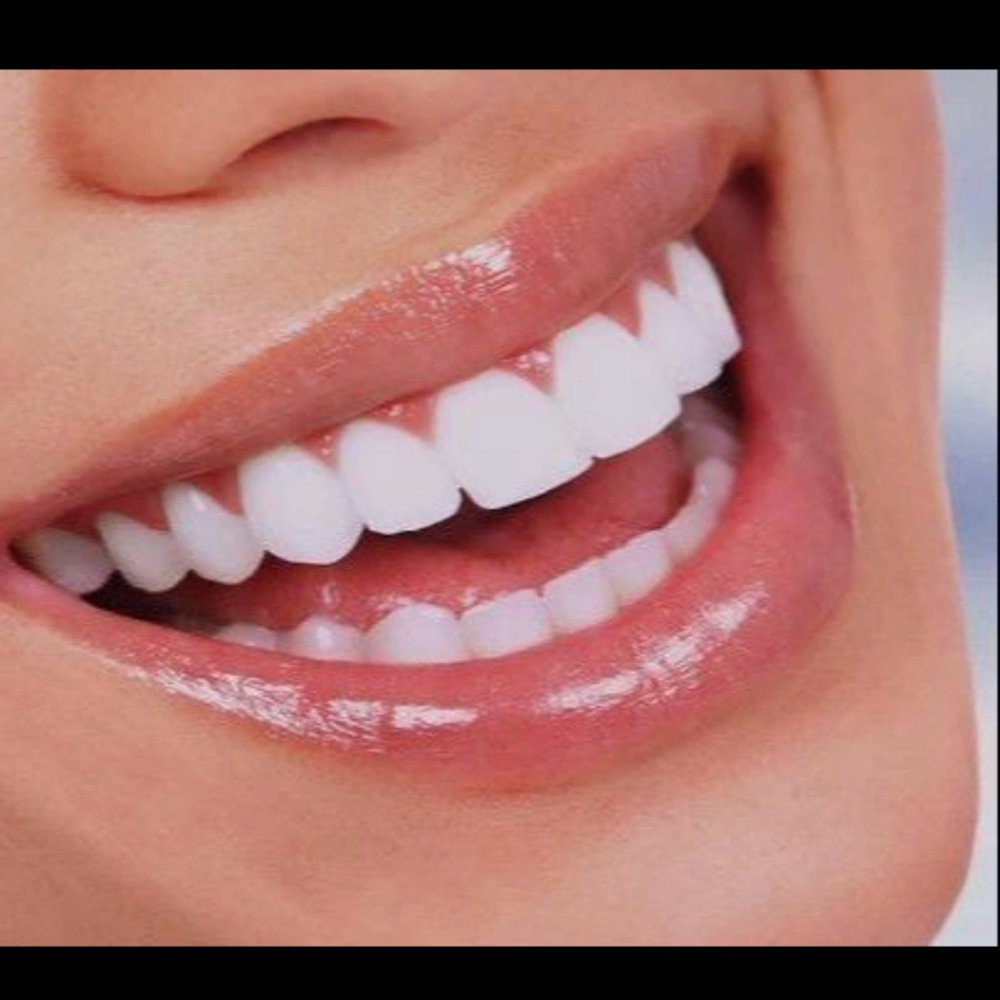 Teeth Whitening Option:3