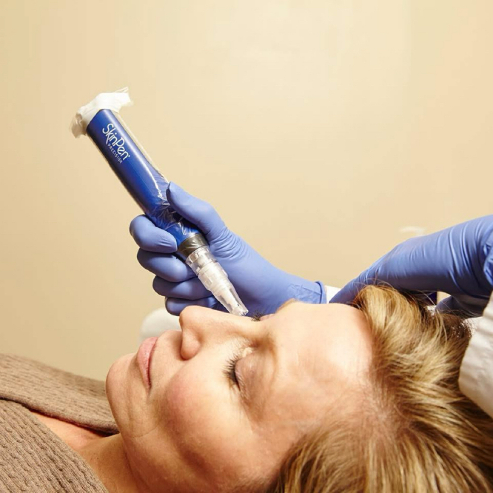 Microneedling for Face at Fresh Complexions in Saint Helens, OR
