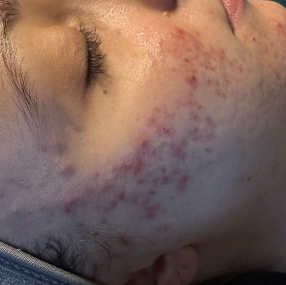 Acne / Sensitive Skin Facial at Onyx | Esthetics Co. in Dequeen, AR