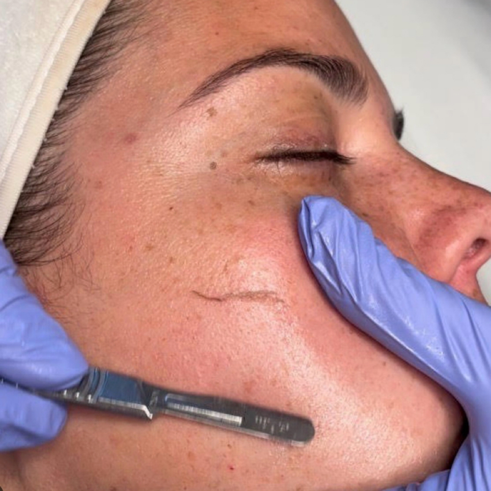 Dermaplane w/Facial at Shear Beaute in Cheyenne, WY
