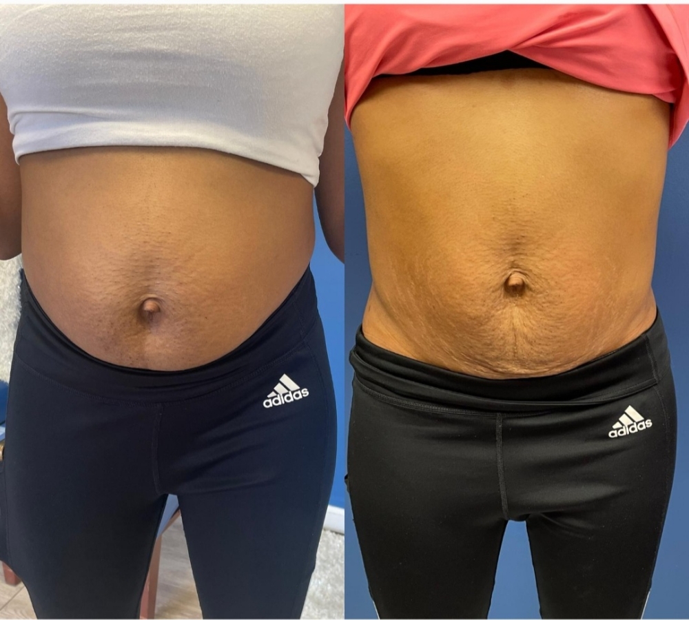 TSHAPE2 BODY SCULPTING at cryo Body Contour in Riverdale, GA