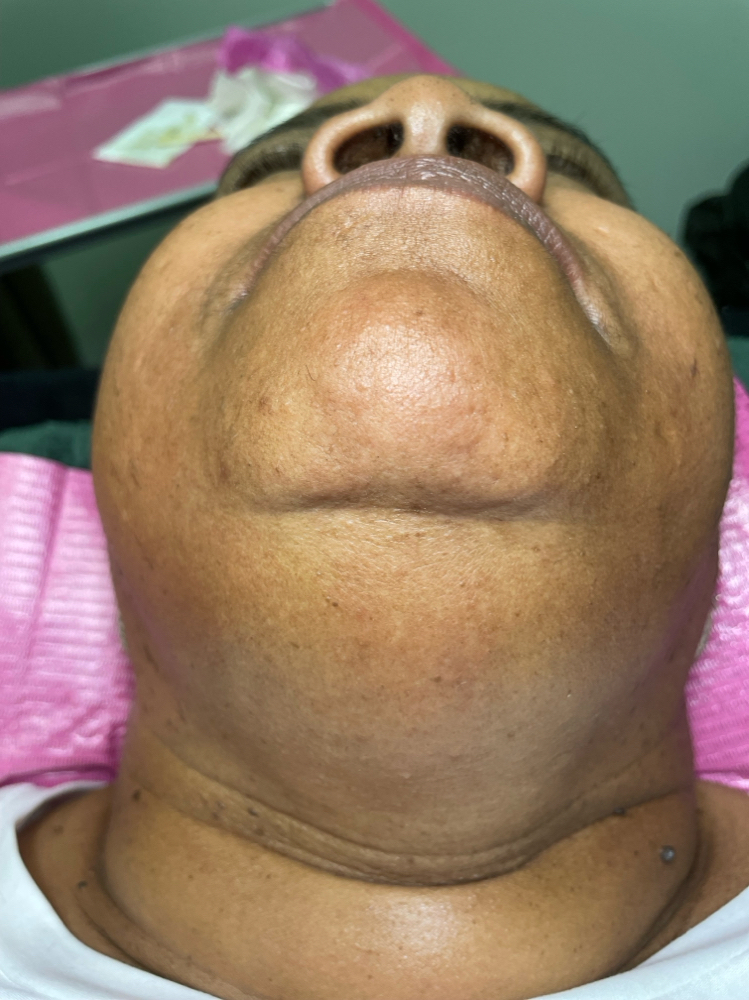 Chin/Neck Wax