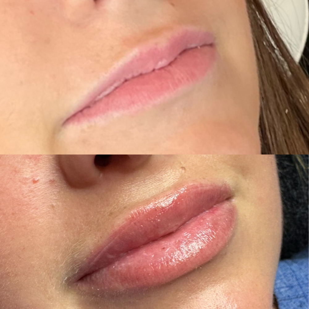 Lip Filler
