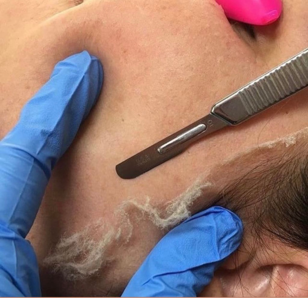 Dermaplaning Add On