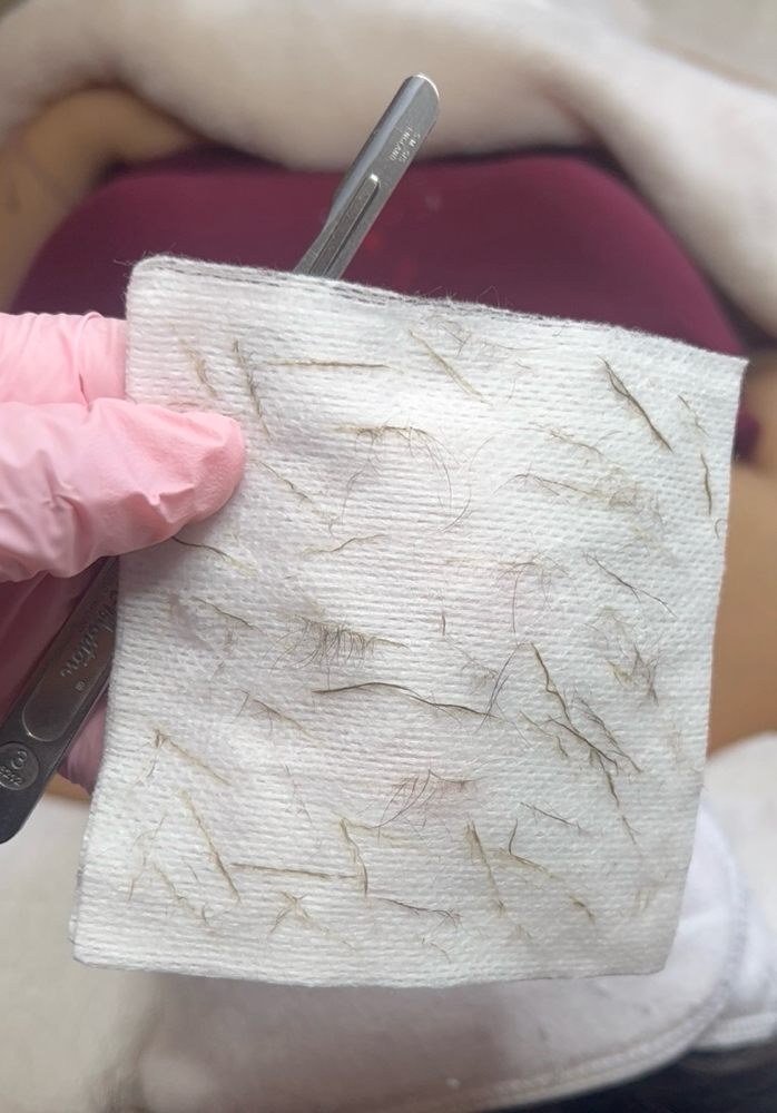 Dermaplaning