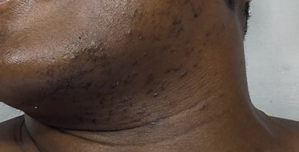 Facial Wax (Cheeks/Chin/&Neck area)