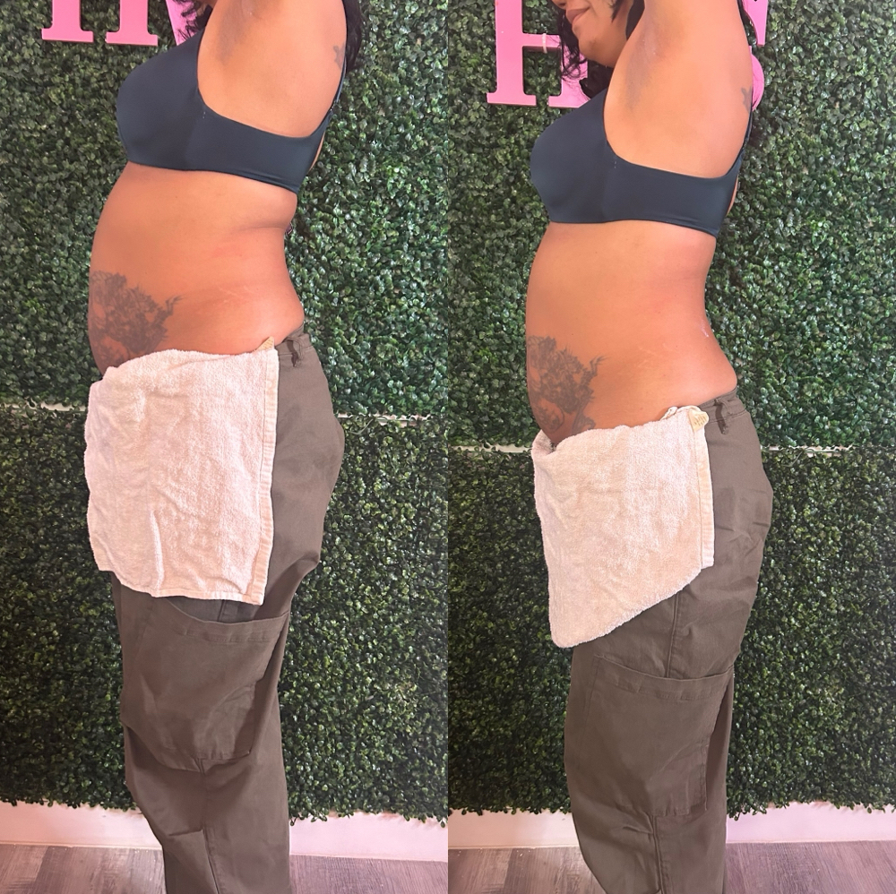 Tax Special Lipo Shots at HVS BODY in Shaker Hts, OH