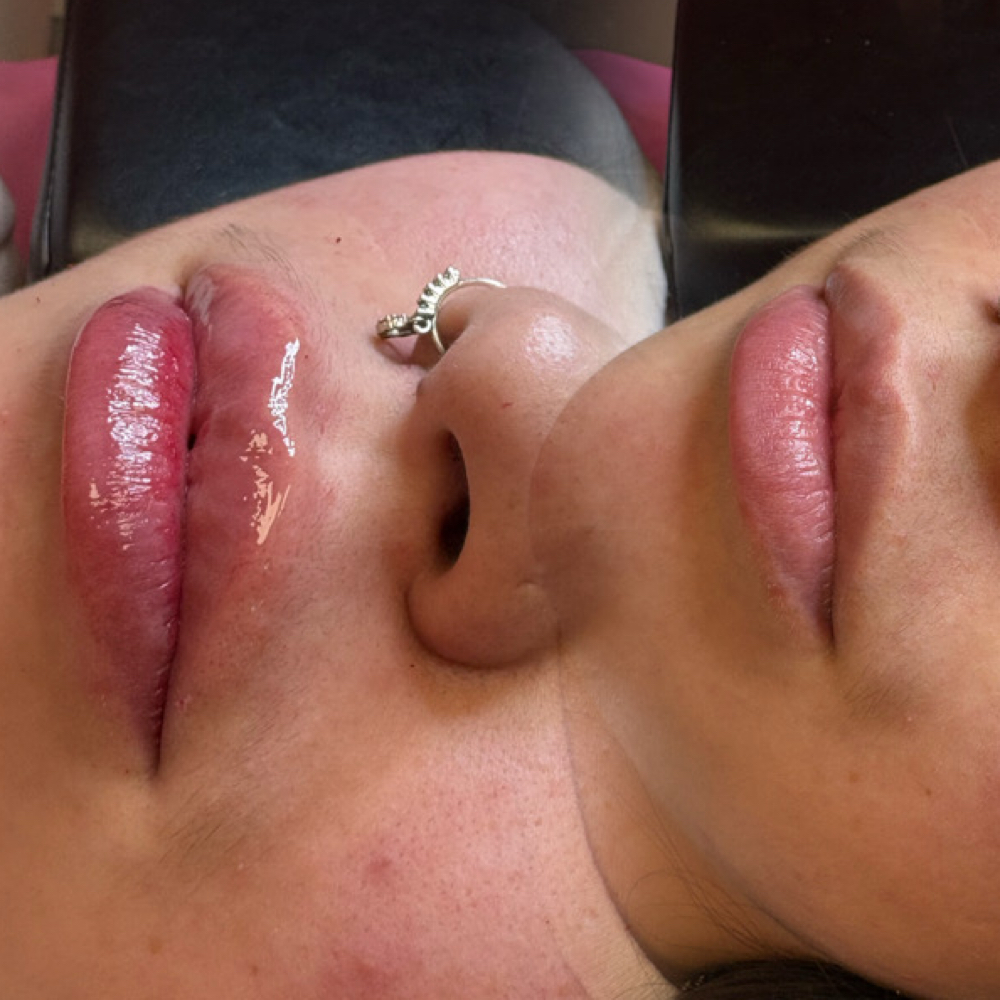 Blushing Lip Filler 1ML at Make Me Pretty Aesthetics in Kansas City, MO