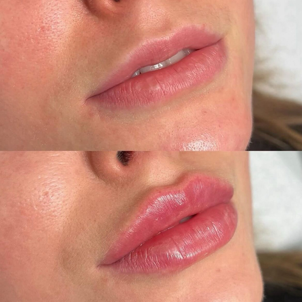 Lip Filler at La Belle Aesthetics & Wellness in Hellertown, PA