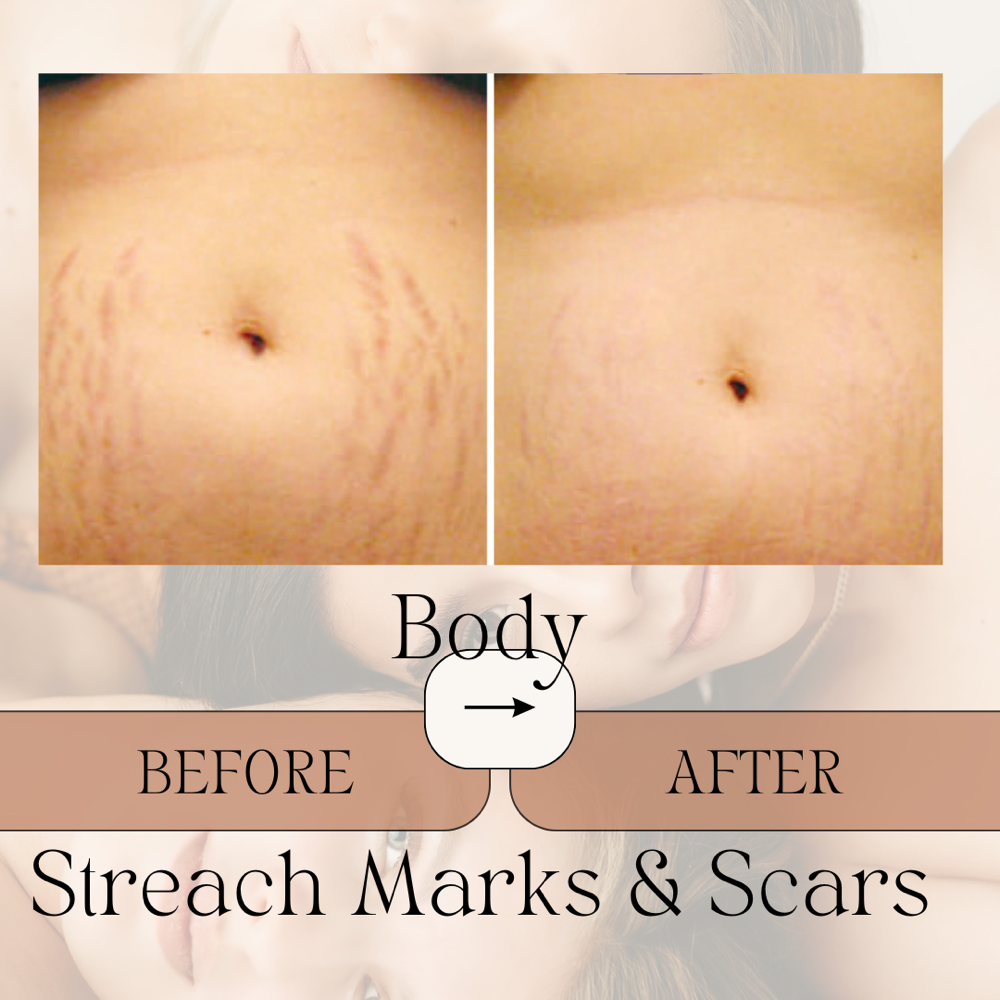 Anti- Streach Marks & Scars - Body