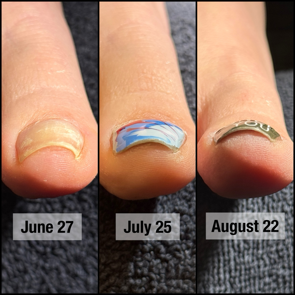 B/S Brace - Left Toenail