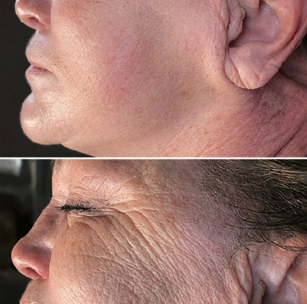 Microchanneling - Anti Aging at BE TRU BEAUTY SPA in Fairfield, CT