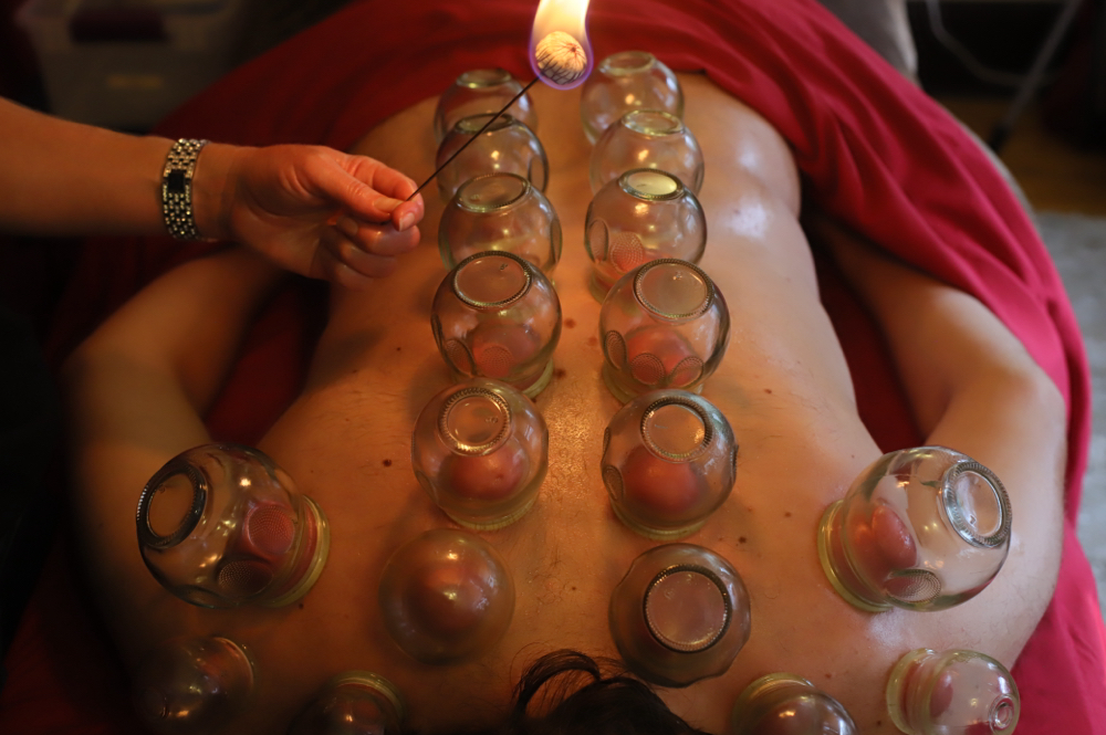 Hijama (Wet) Cupping Session at Acupuncture North in Minneapolis, MN