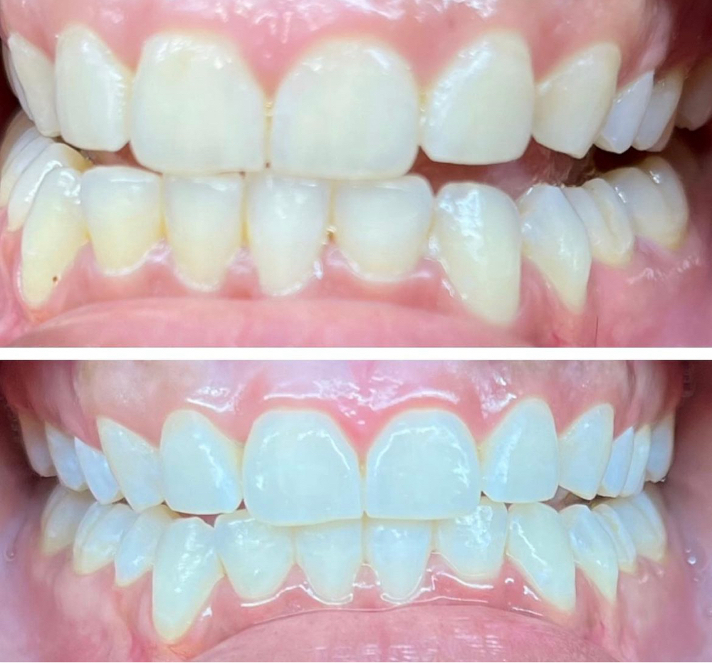 Teeth Whitening 60 Min
