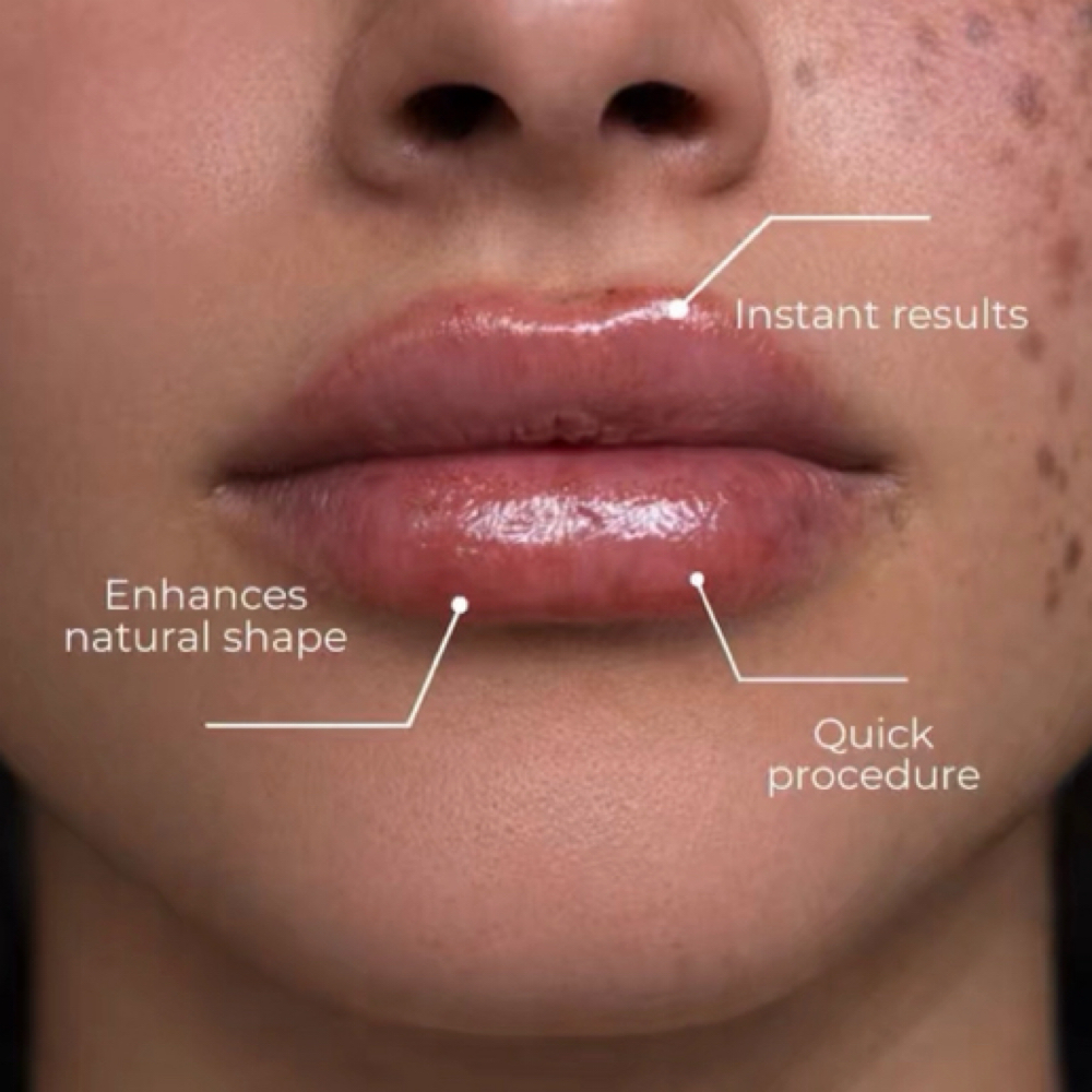 Russian Lips at CP Aesthetics in Dallas, TX