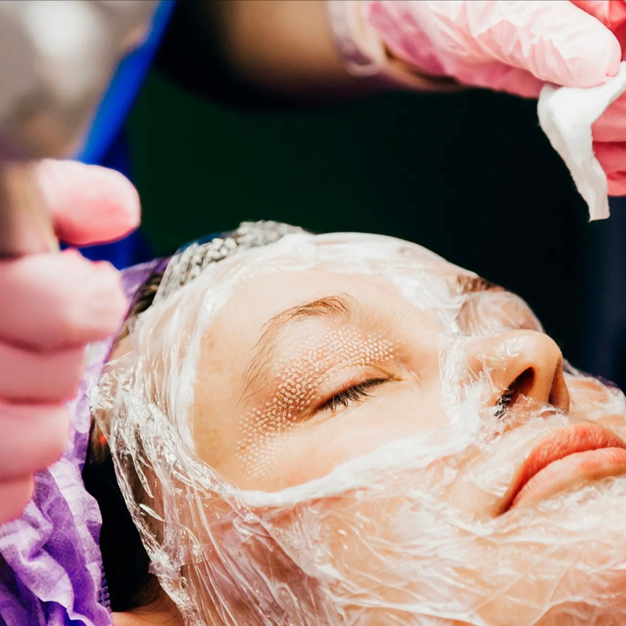 👀CO₂ Eye Renewal – Upper + Lower