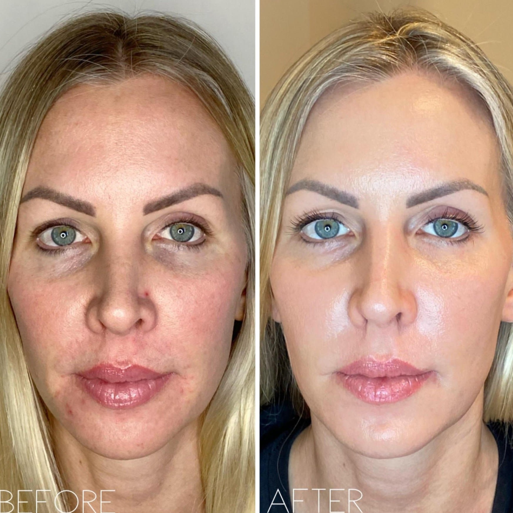 Fibroblast (Hot Plasma) at Body Essentials HSV, Wellness and Beauty LLP in Huntsville, AL