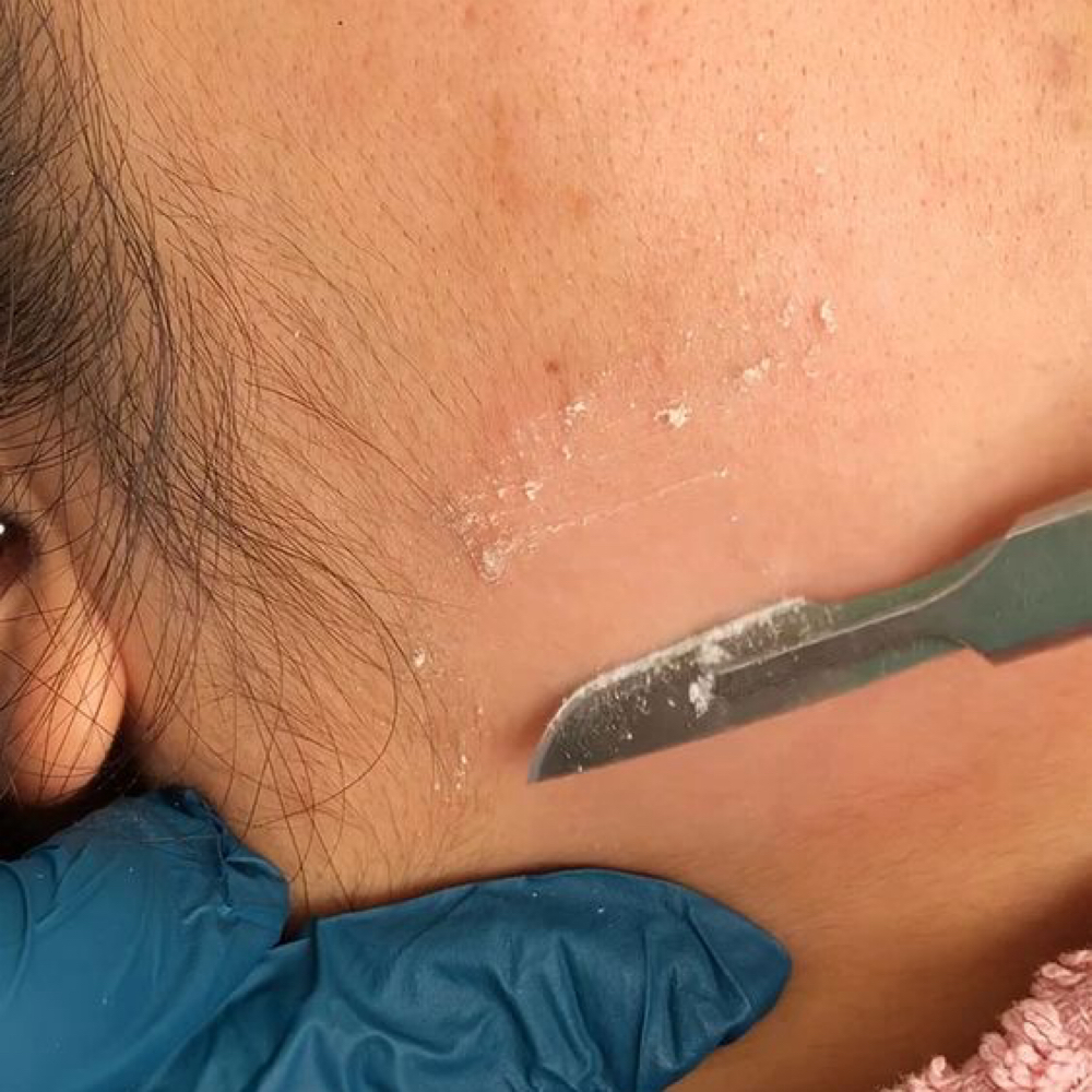 Dermaplaning Treatment