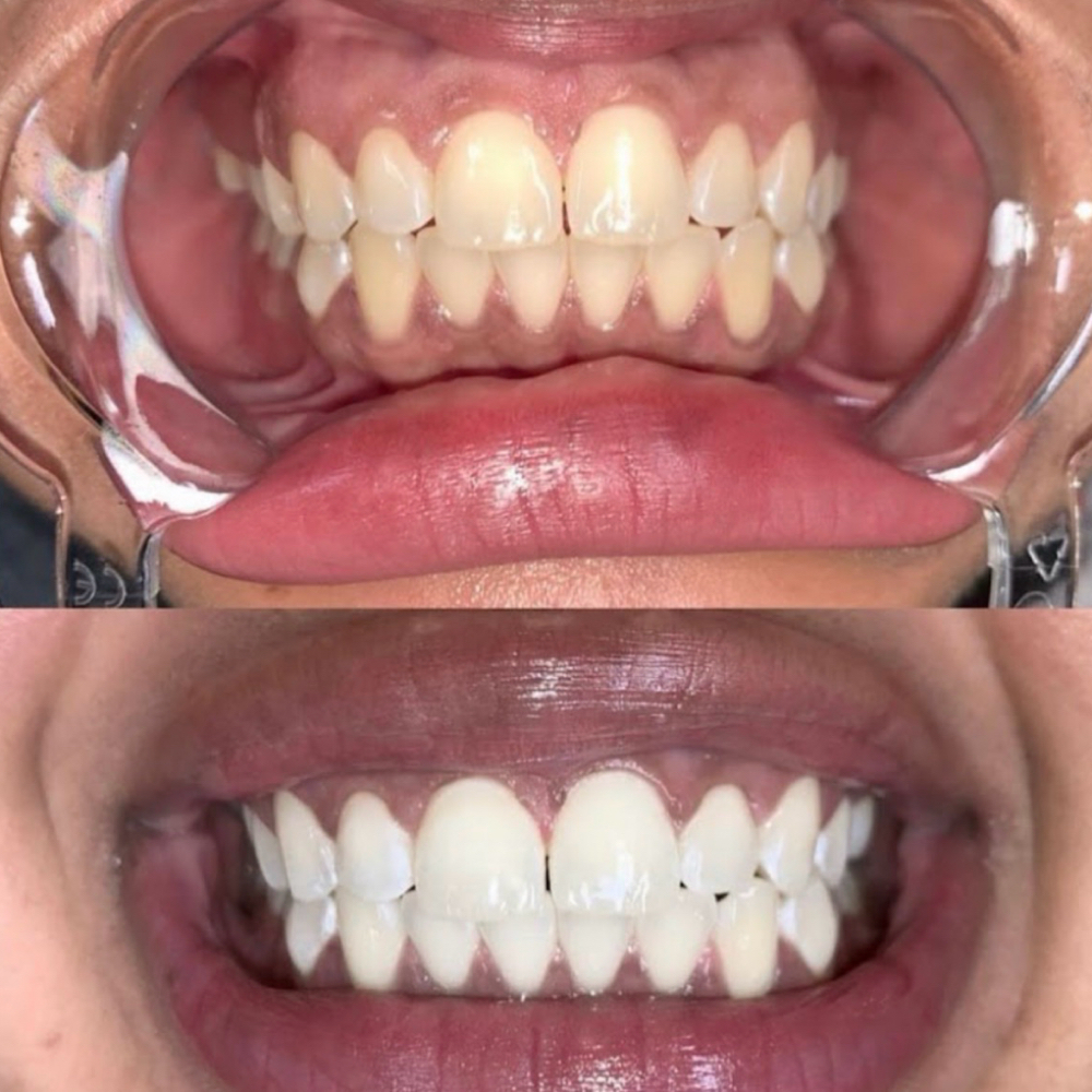 ✨ SIGNATURE WHITENING at Golden Luxe Aesthetics in Indianapolis, IN