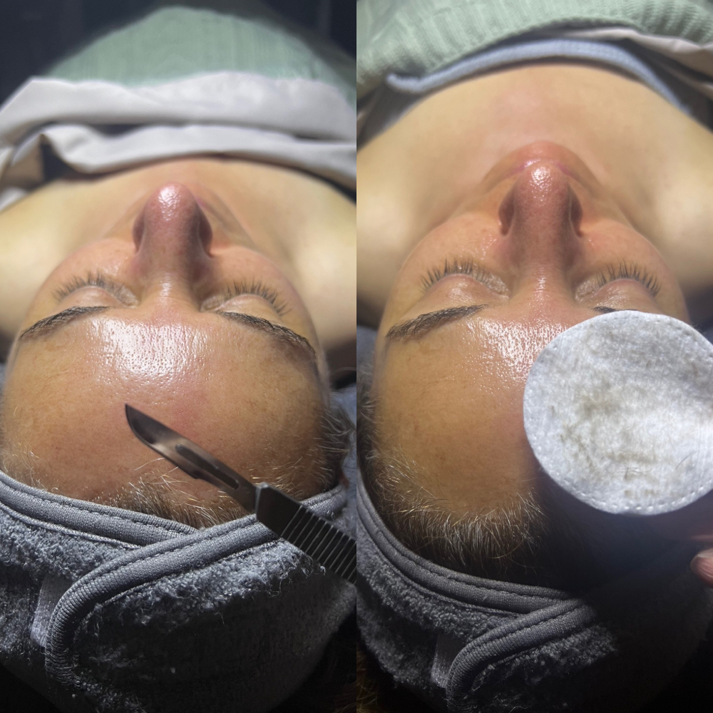 Dermaplaning Facial