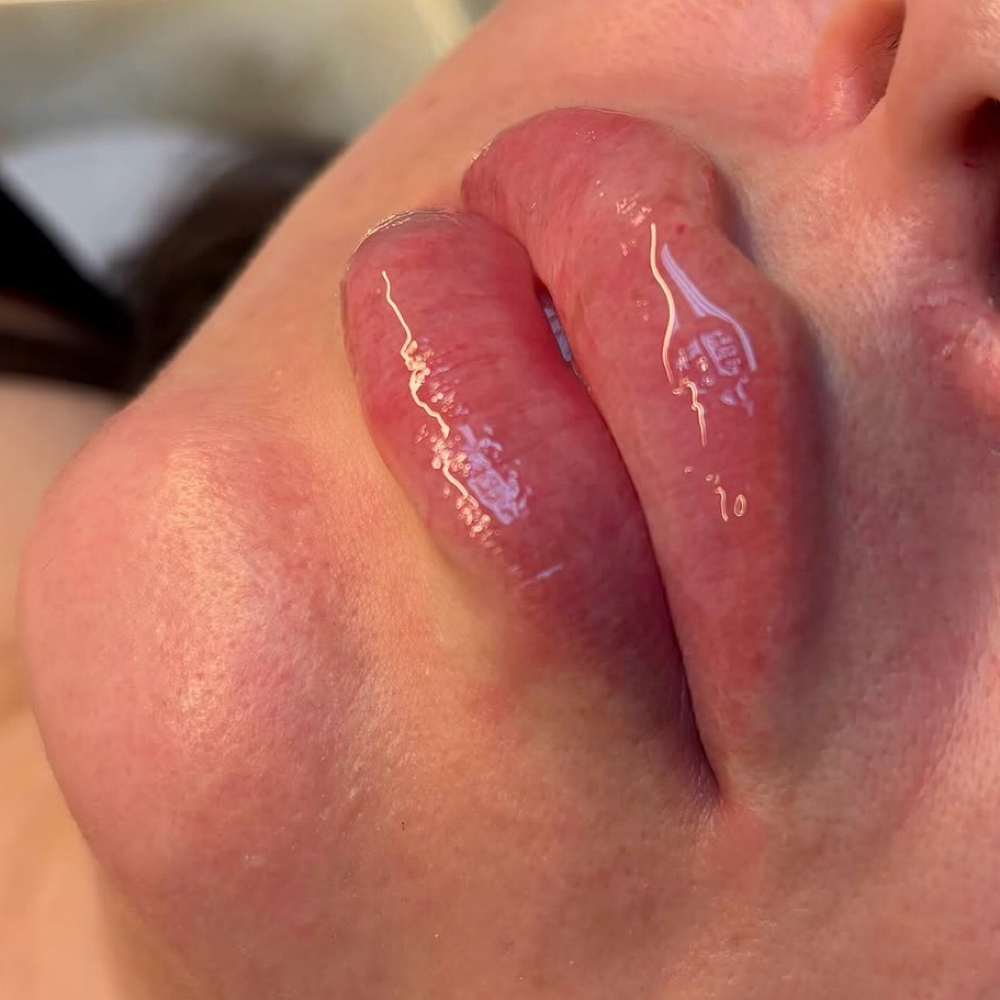 30 Units Botox & Lip Package .5ml at AlamoAestheticsStudio in San Antonio, TX