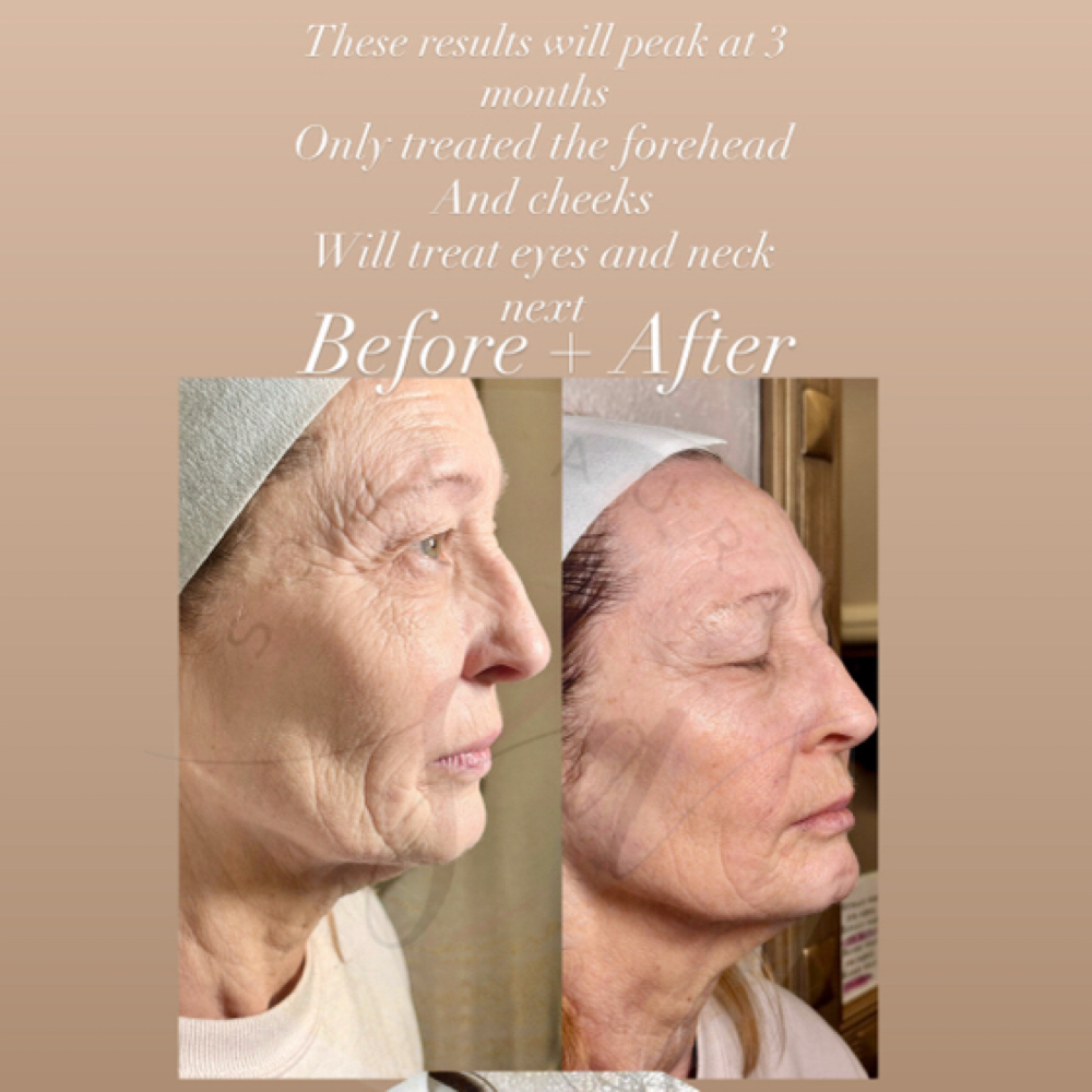 Advanced  RF  Skin Tightening