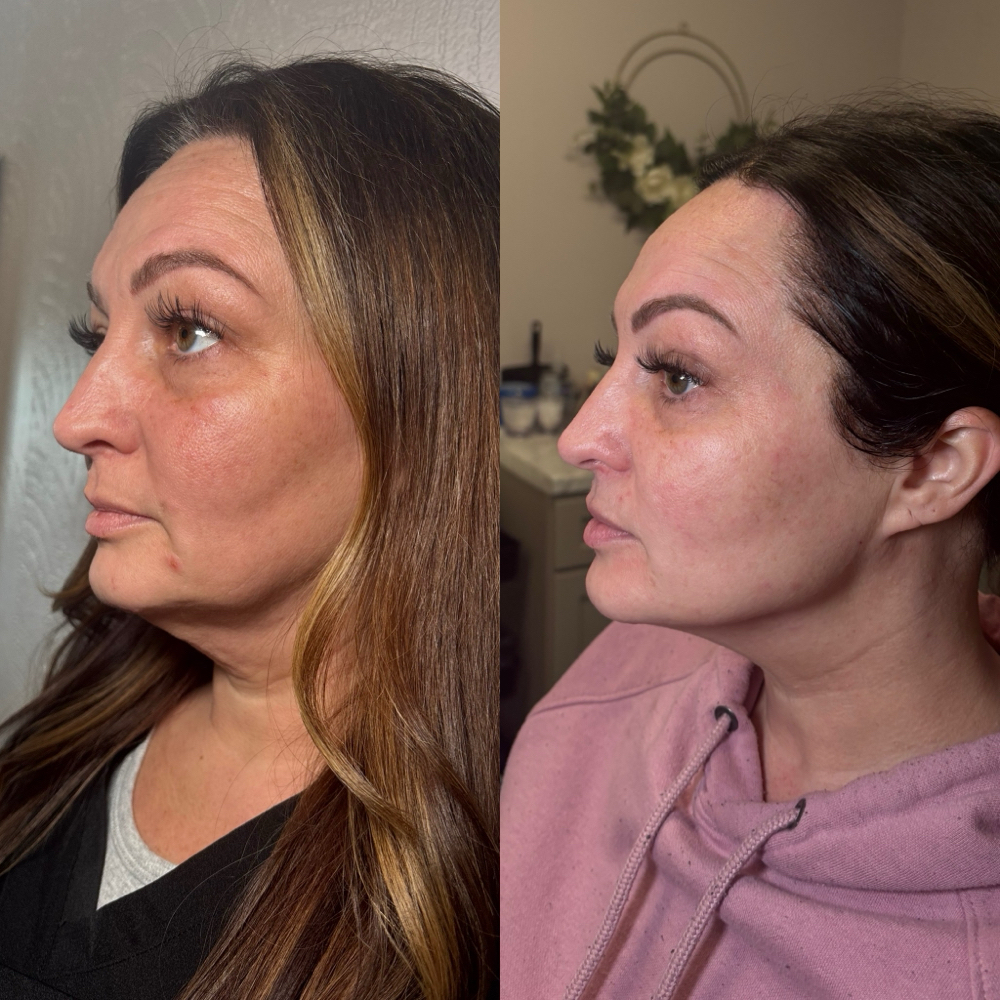 Advanced RF Skin Tightening at Soul Aura in Indian Orchard, MA