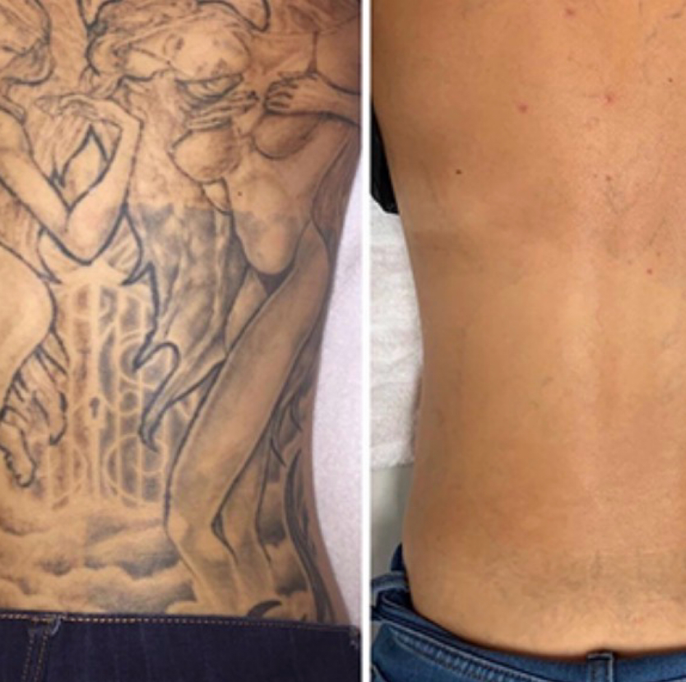 Laser Tattoo Removal - XL Area at NICHÉ in Lewisville, TX