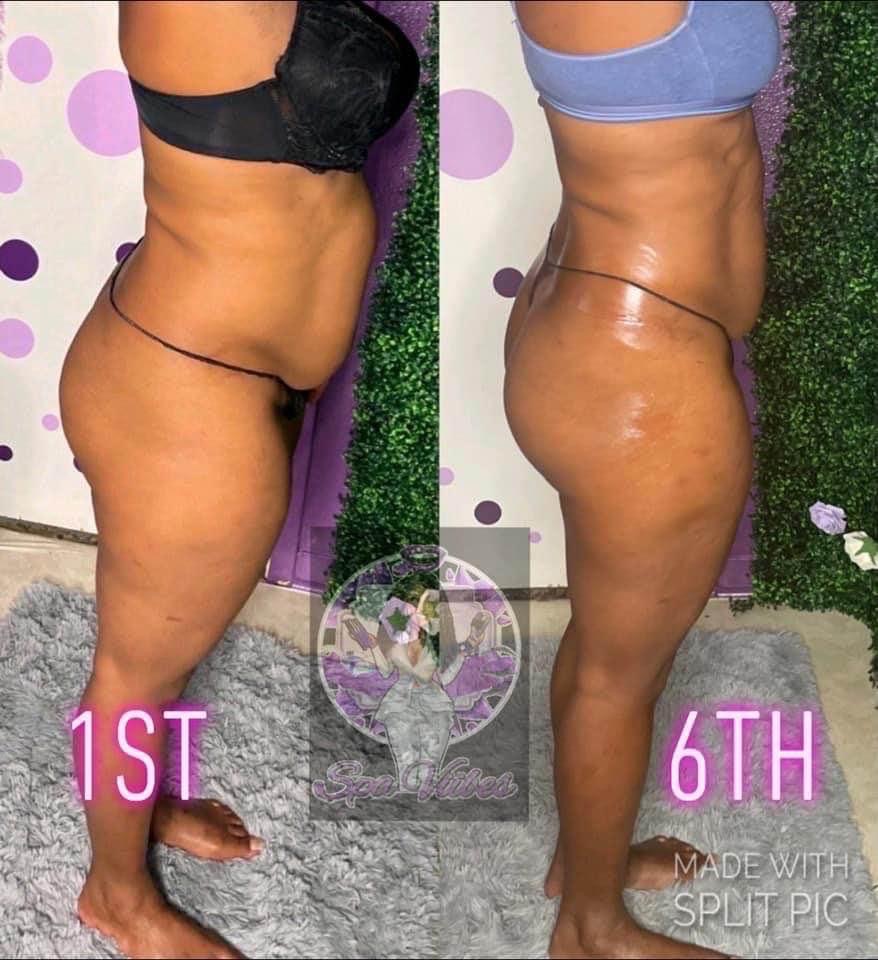 Non Surgical Lipo 30mins