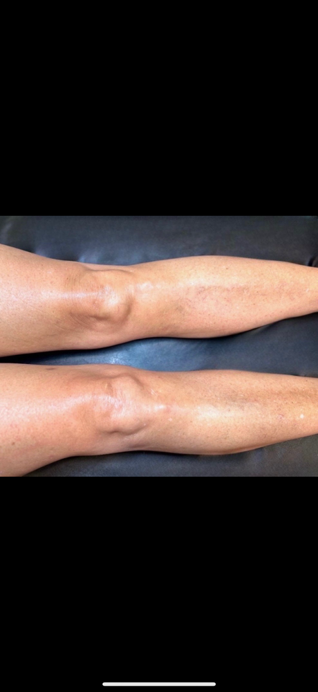 Upper Leg at Bare&bloom wax in Gansevoort, NY