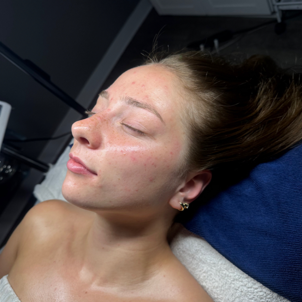 Skin Reset Acne Facial + LED Panel