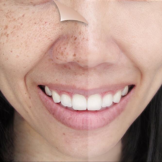 Skin Bleaching at perrenia wellness in Shallotte, NC