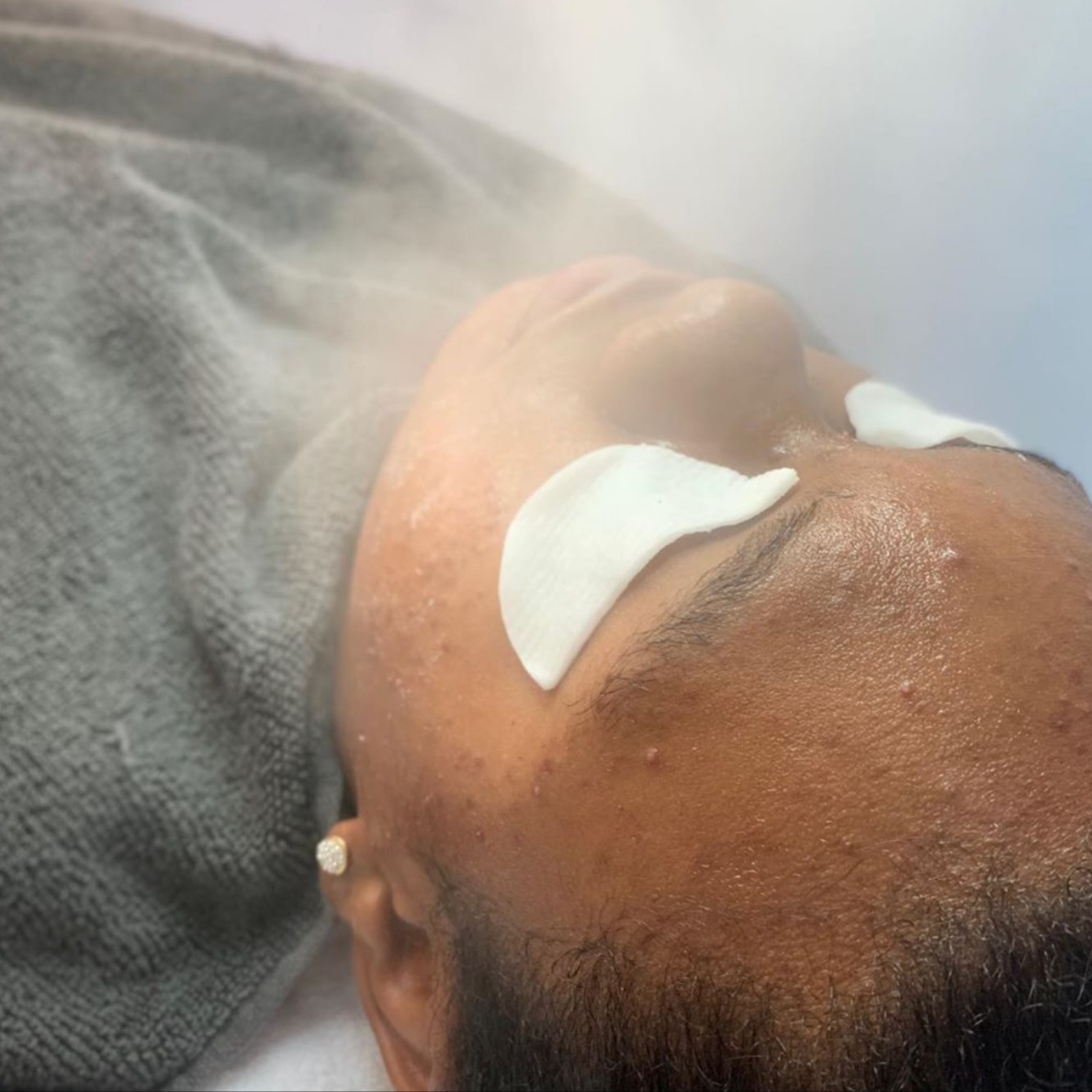 Acne-Scar Revision Treatment at Anastacia Beauty Lounge in Lake Park, FL