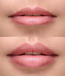 Lip Filler 1/2 Syringe
