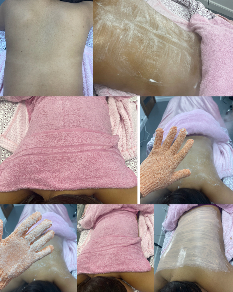 Bacial (back facial)