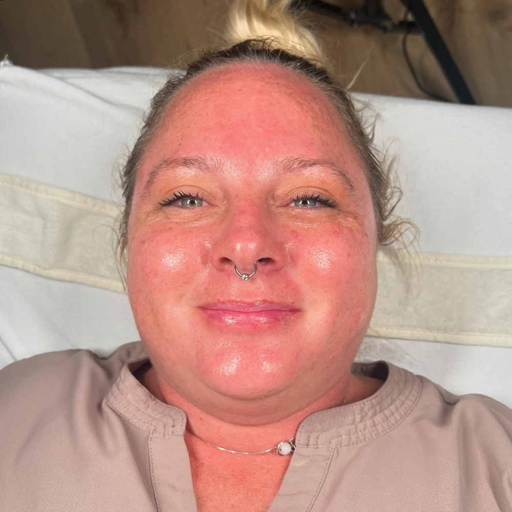 Dermaplane Facial