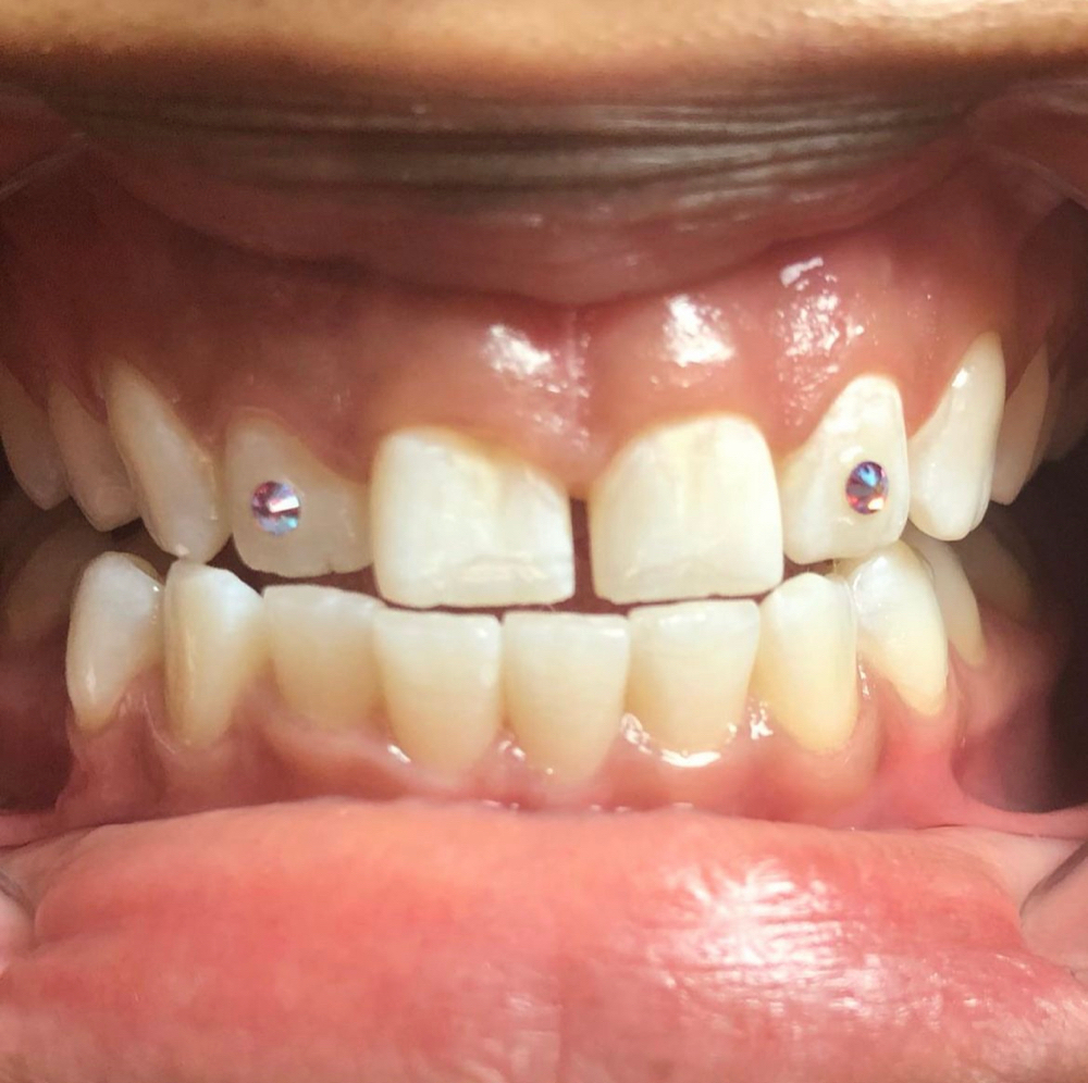 2 Crsytal Tooth Gems