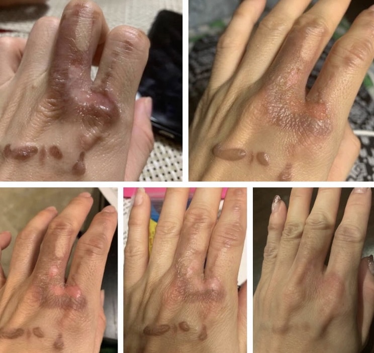 Scar Treatment By Plasma