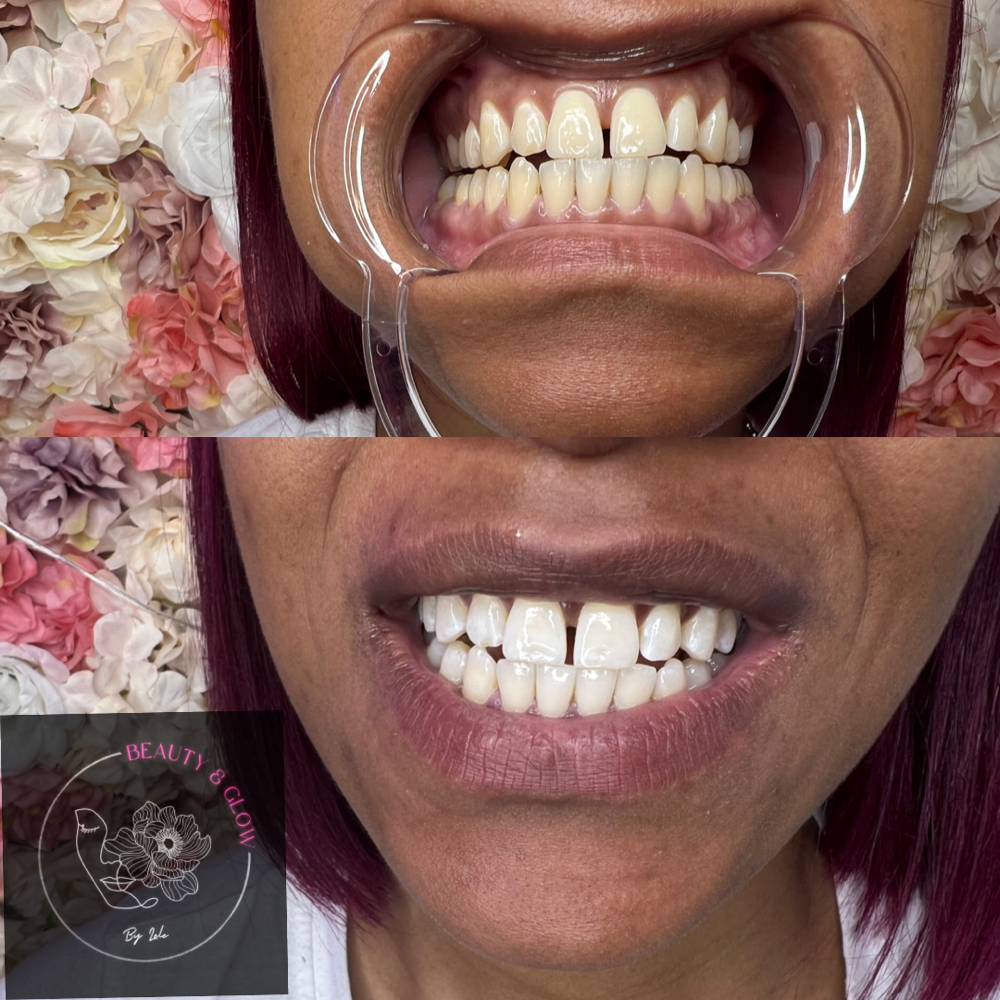 Tooth Whitening