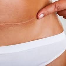 Tummy Tuck Scar Reduction