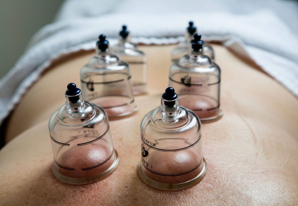 Static Cupping