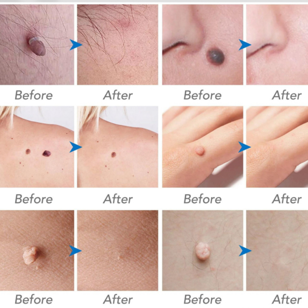 Skin Tag, Warts and Mole Removal at Donna Katsabas Aesthetics in Katy, TX