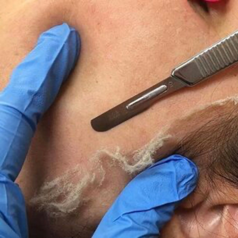 Dermaplaning Treatment