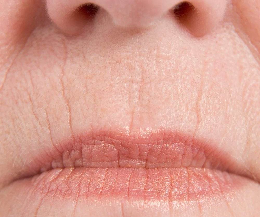Perioral Rhytids (Smoker’s Lines)